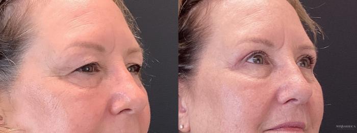 Before & After Eyelid Surgery Case 351 Right Side View in St. Louis, MO