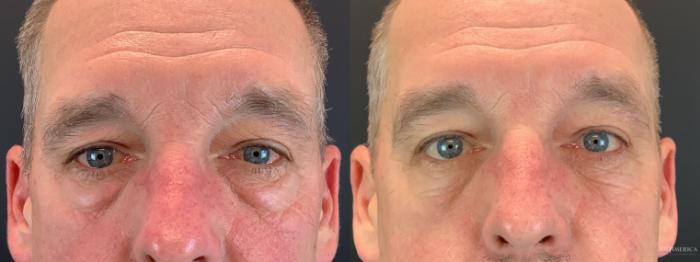 Before & After Eyelid Surgery Case 352 Front View in St. Louis, MO