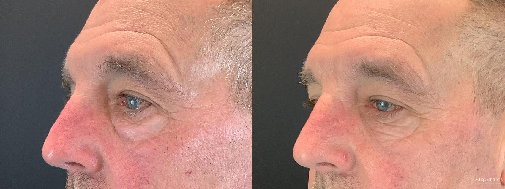 Before & After Eyelid Surgery Case 352 Left Side View in Glen Carbon, IL