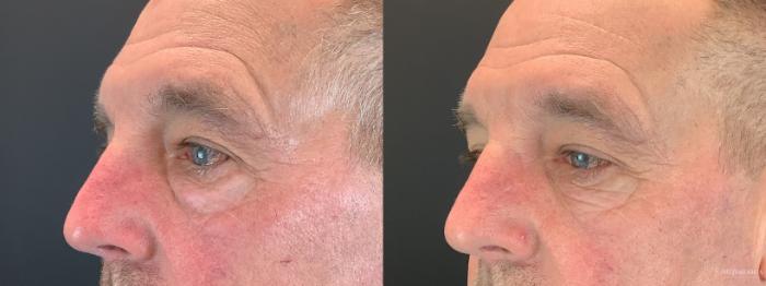 Before & After Eyelid Surgery Case 352 Left Side View in St. Louis, MO