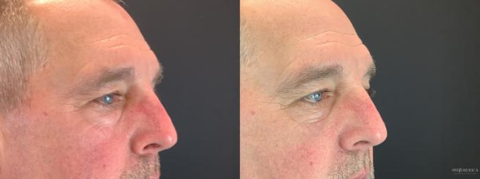 Before & After Eyelid Surgery Case 352 Right Side View in St. Louis, MO