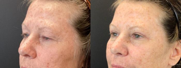 Before & After Eyelid Surgery Case 387 Front View in St. Louis, MO