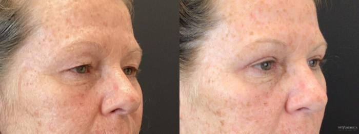 Before & After Eyelid Surgery Case 387 Left Oblique View in St. Louis, MO