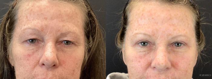 Before & After Eyelid Surgery Case 387 Left Side View in St. Louis, MO