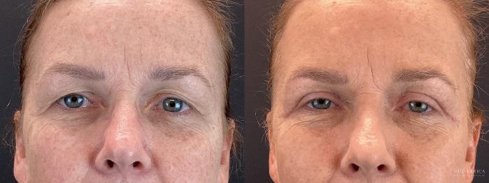 Before & After Eyelid Surgery Case 399 Front View in St. Louis, MO