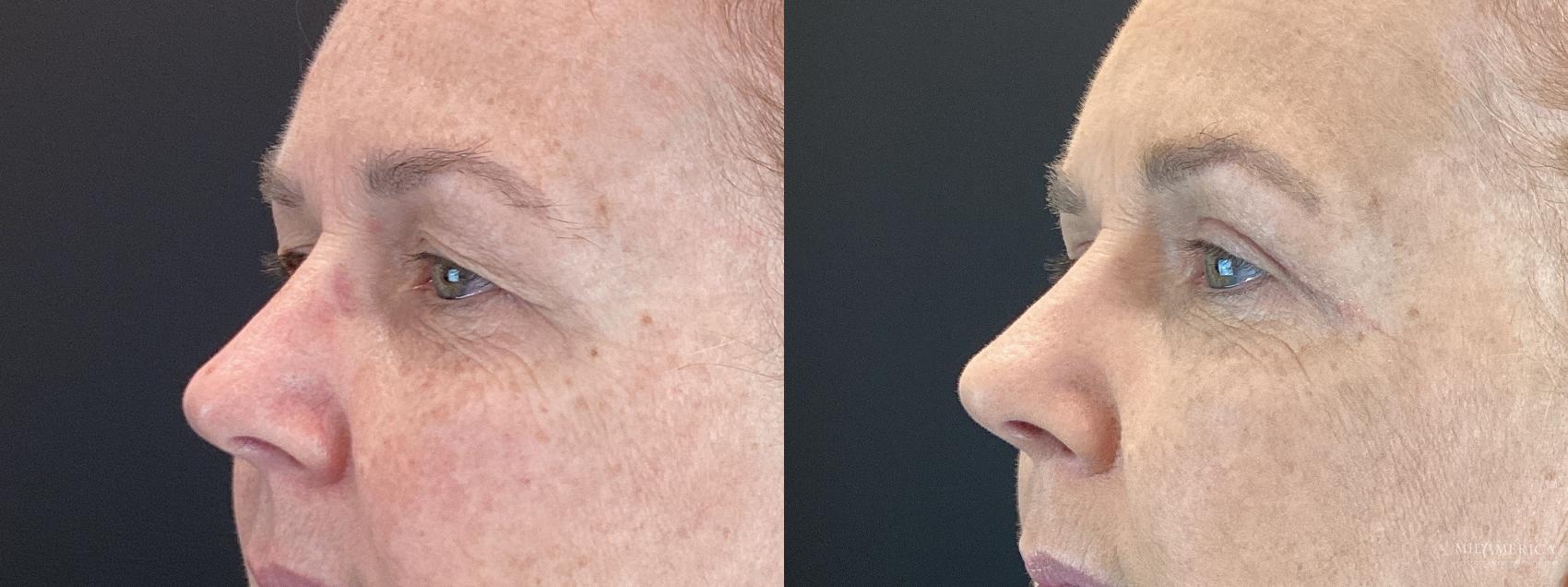 Before & After Eyelid Surgery Case 399 Left Oblique View in St. Louis, MO