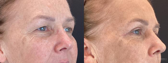 Before & After Eyelid Surgery Case 399 Right Oblique View in St. Louis, MO