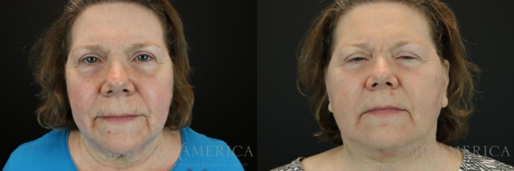 Facelift – St. Louis, MO & Glen Carbon, IL – MidAmerica Plastic Surgery