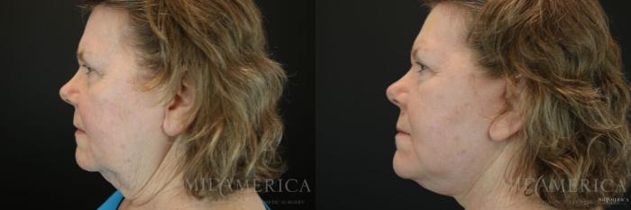 Before & After Facelift Case 109 View #3 View in St. Louis, MO