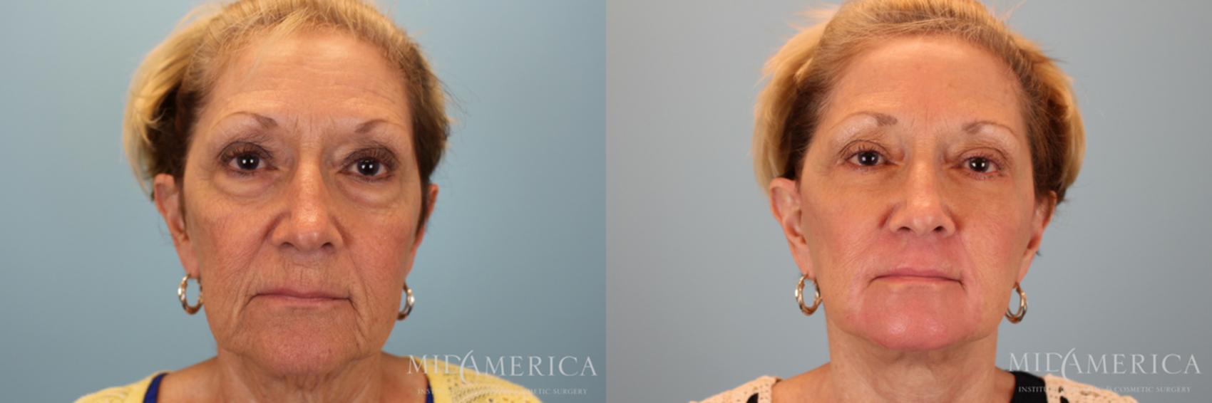 Before & After Facelift Case 30 View #1 View in St. Louis, MO