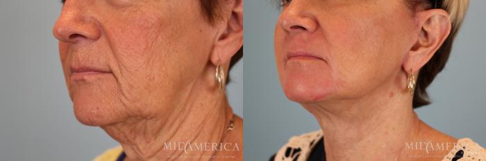 Before & After Facelift Case 30 View #6 View in Glen Carbon, IL