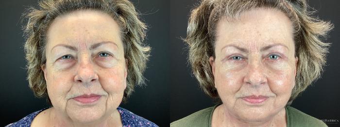 Before & After Facelift Case 307 Front View in St. Louis, MO