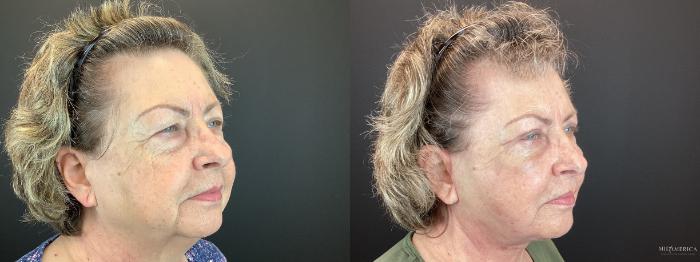 Before & After Facelift Case 307 Right Oblique View in St. Louis, MO