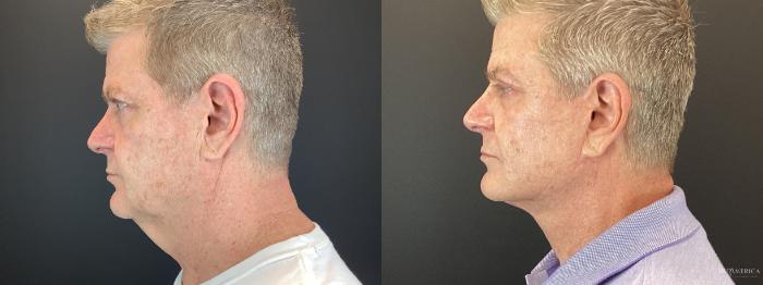 Before & After Facelift Case 385 Left Oblique View in St. Louis, MO