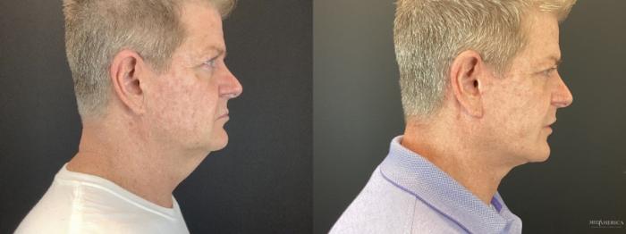 Before & After Facelift Case 385 Right Oblique View in St. Louis, MO