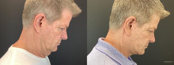 Before & After Facelift Case 385 Right Side View in St. Louis, MO
