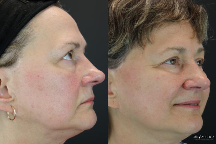 Before & After Laser Services  Case 185 Right Side View in St. Louis, MO