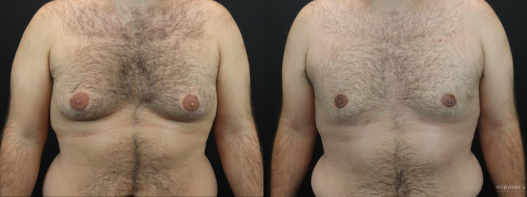 Before & After Gynecomastia Case 263 Front View in Glen Carbon, IL