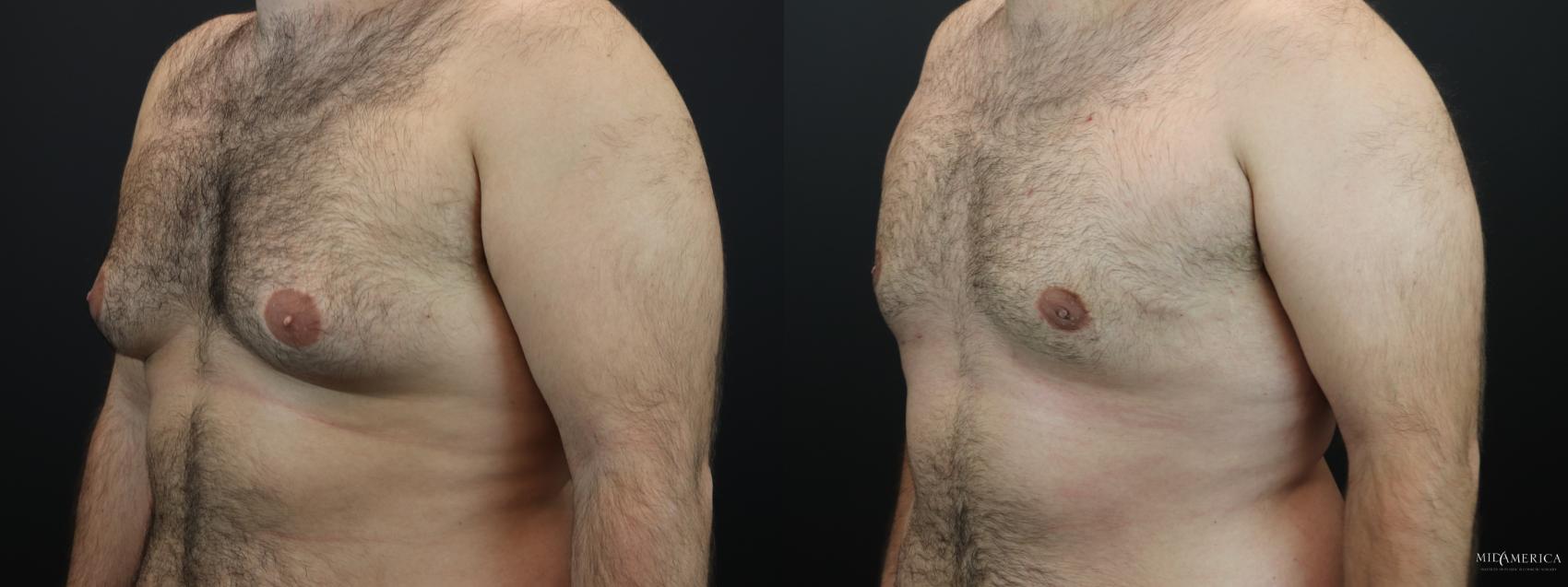 Before & After Gynecomastia Case 263 Left Oblique View in Glen Carbon, IL