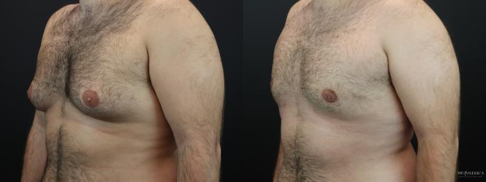 Before & After Gynecomastia Case 263 Left Oblique View in St. Louis, MO