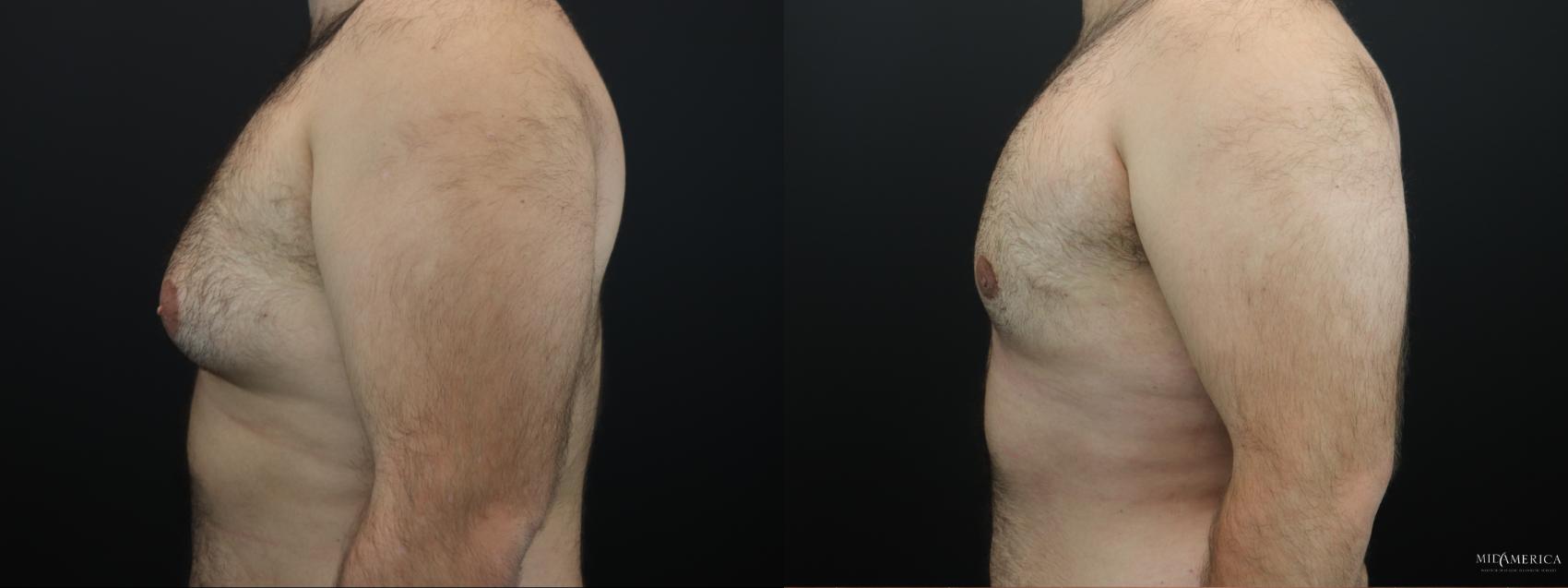 Before & After Gynecomastia Case 263 Left Side View in Glen Carbon, IL