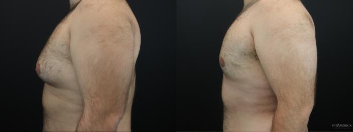 Before & After Gynecomastia Case 263 Left Side View in St. Louis, MO