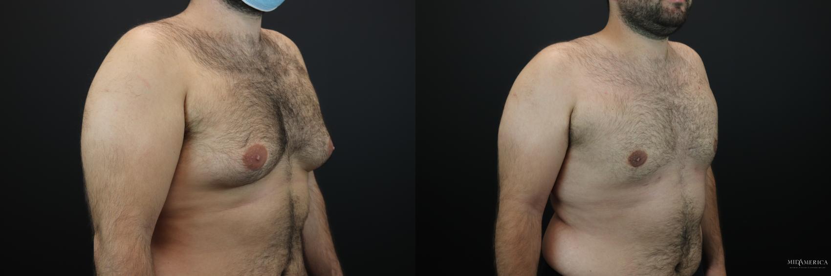 Before & After Gynecomastia Case 263 Right Oblique View in Glen Carbon, IL