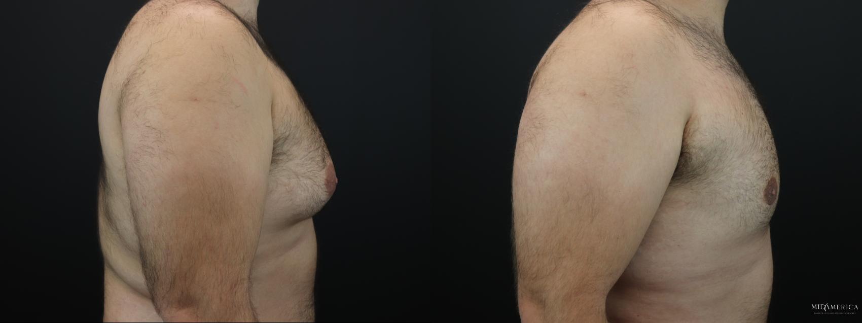 Before & After Gynecomastia Case 263 Right Side View in Glen Carbon, IL