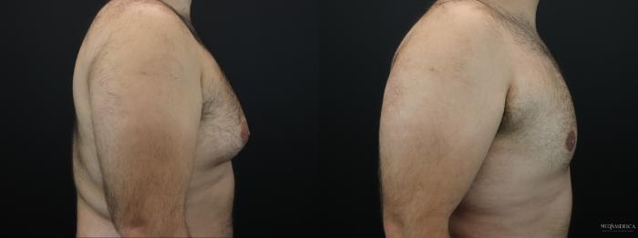 Before & After Gynecomastia Case 263 Right Side View in St. Louis, MO