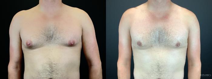 Before & After Gynecomastia Case 298 Front View in Glen Carbon, IL