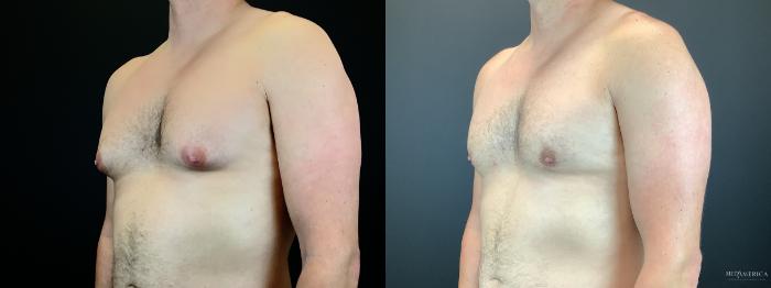 Before & After Gynecomastia Case 298 Left Oblique View in Glen Carbon, IL