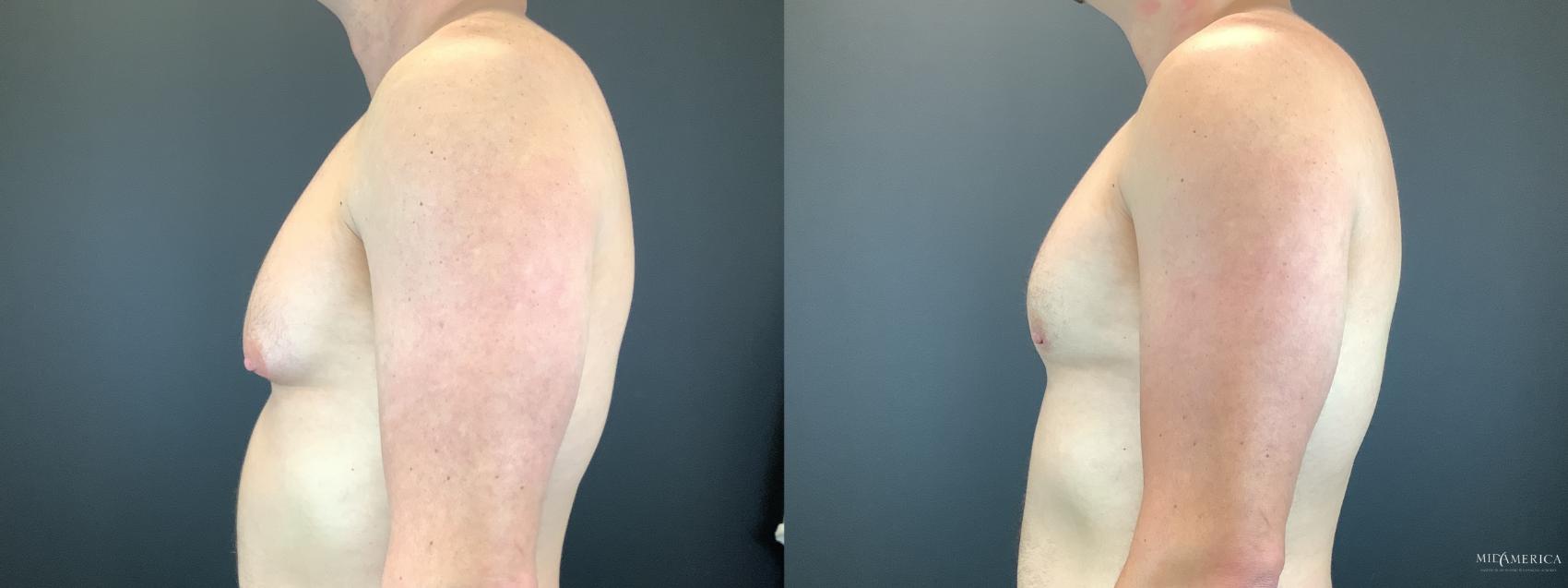 Before & After Gynecomastia Case 298 Left Side View in Glen Carbon, IL