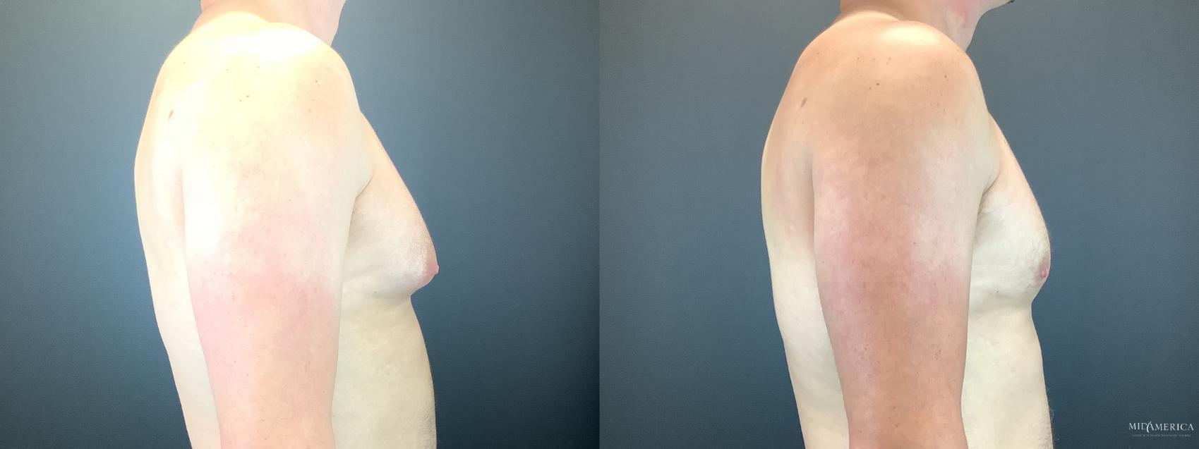 Before & After Gynecomastia Case 298 Right Side View in Glen Carbon, IL