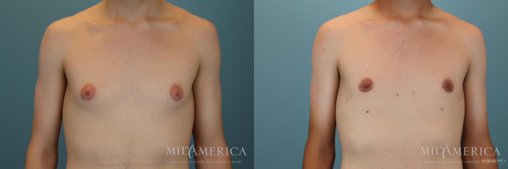 Before & After Gynecomastia Case 50 View #1 View in Glen Carbon, IL