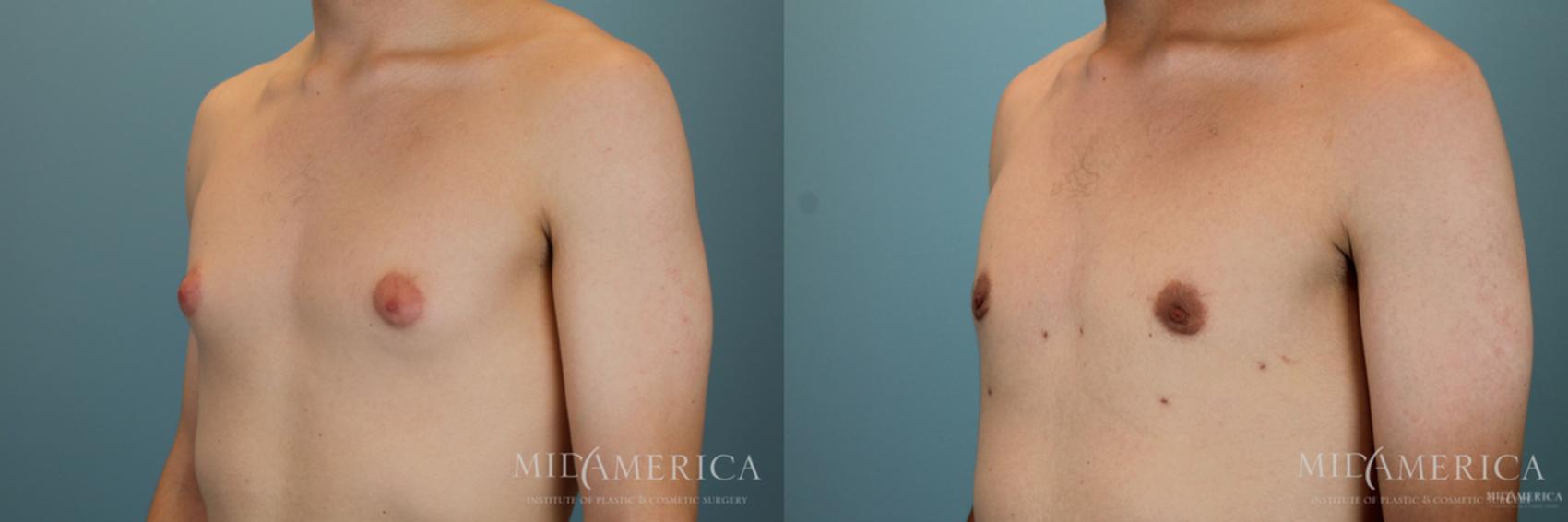 Before & After Gynecomastia Case 50 View #2 View in Glen Carbon, IL