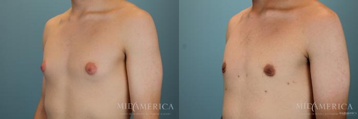Before & After Gynecomastia Case 50 View #2 View in St. Louis, MO