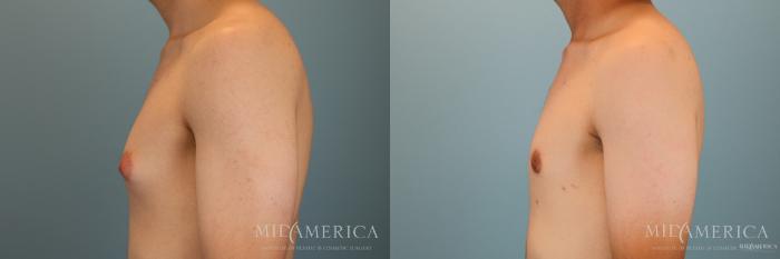 Before & After Gynecomastia Case 50 View #3 View in St. Louis, MO