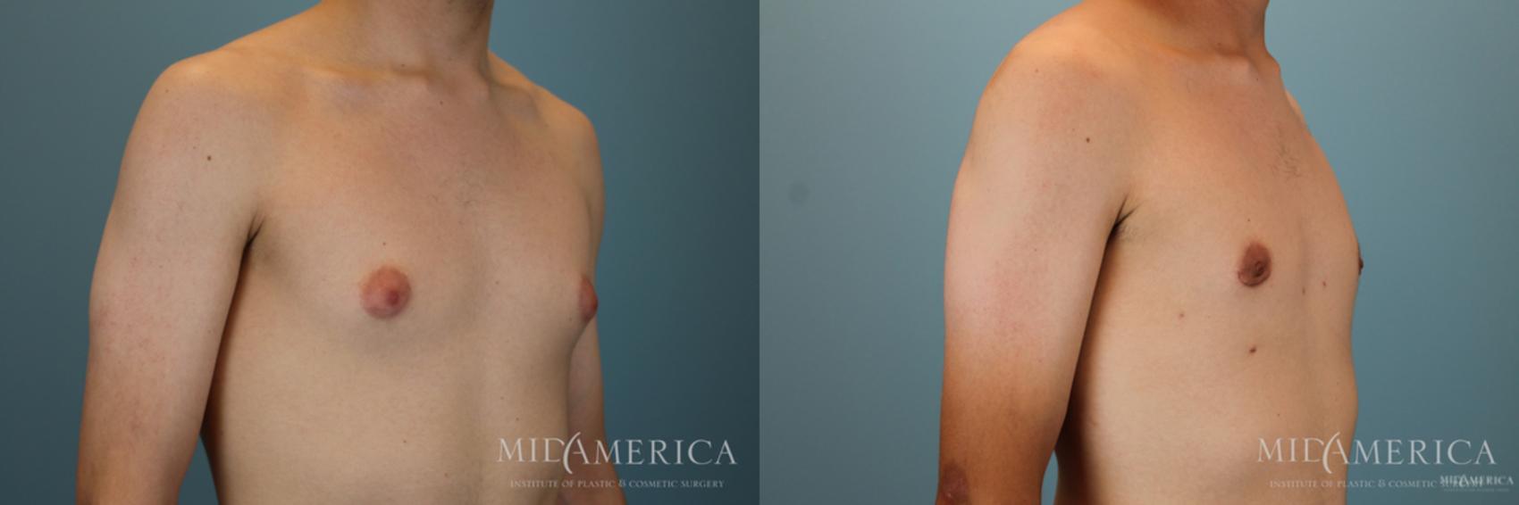 Before & After Gynecomastia Case 50 View #4 View in Glen Carbon, IL