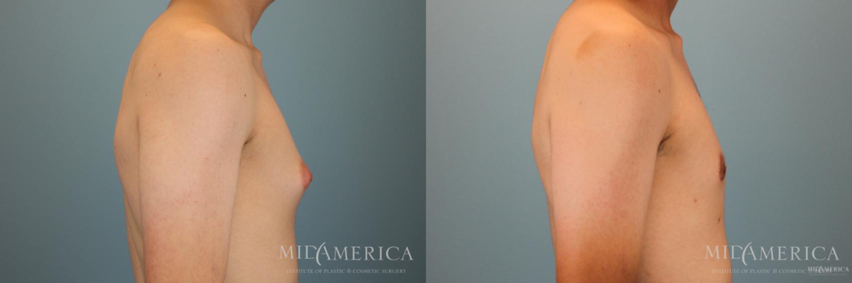 Before & After Gynecomastia Case 50 View #5 View in Glen Carbon, IL