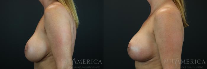 Before & After Implant Exchange Case 144 View #3 View in St. Louis, MO