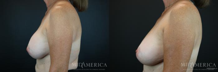 Before & After Implant Exchange Case 175 View #3 View in St. Louis, MO