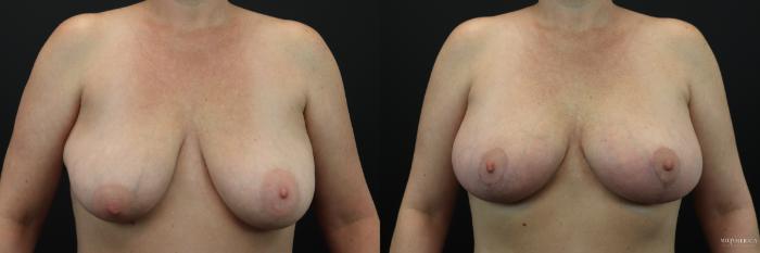Before & After Breast Lift Case 215 Front View in St. Louis, MO