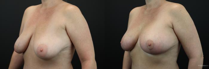 Before & After Breast Lift Case 215 Left Oblique View in St. Louis, MO