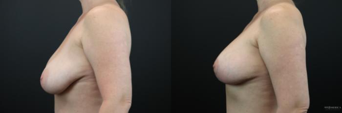 Before & After Breast Lift Case 215 Left Side View in St. Louis, MO