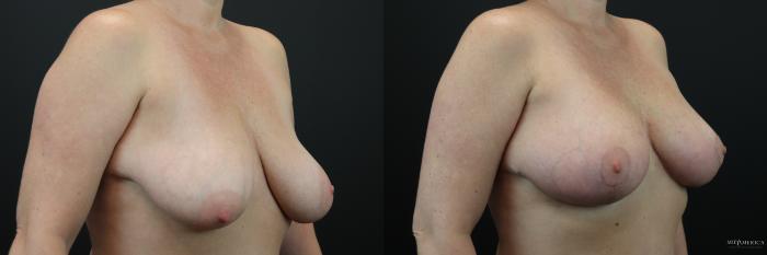 Before & After Breast Lift Case 215 Right Oblique View in St. Louis, MO
