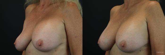 Before & After Implant Exchange Case 222 Left Oblique View in St. Louis, MO