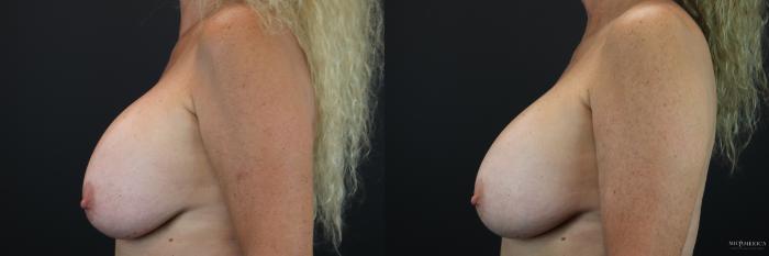 Before & After Implant Exchange Case 222 Left Side View in St. Louis, MO
