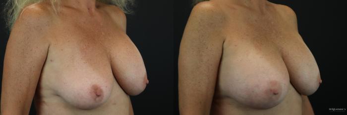 Before & After Implant Exchange Case 222 Right Oblique View in St. Louis, MO