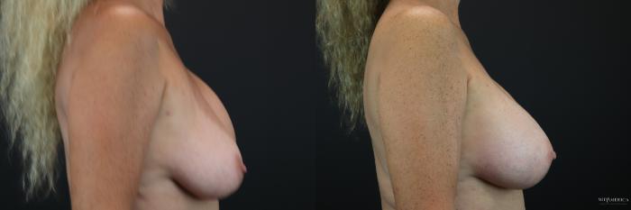 Before & After Implant Exchange Case 222 Right Side View in St. Louis, MO