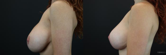 Before & After Breast Lift Case 223 Left Side View in St. Louis, MO
